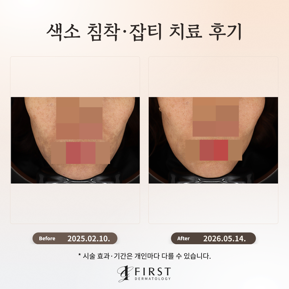 잘못된 피부관리로 생긴 색소질환 치료 후기