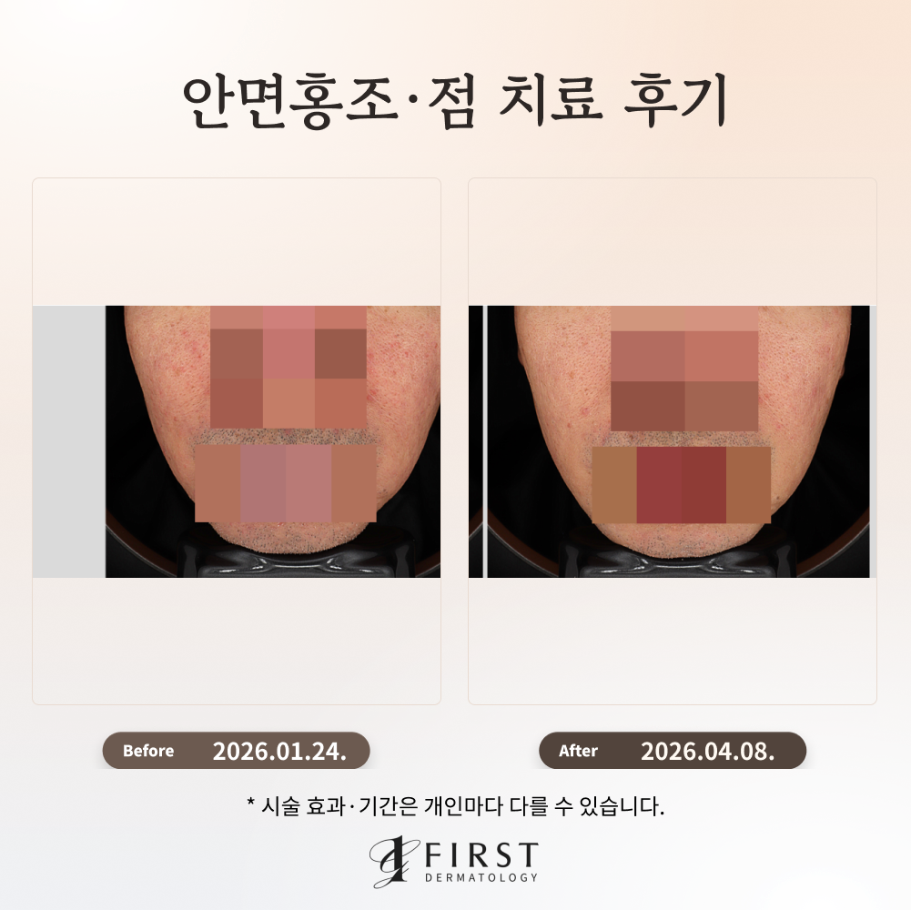 50대 남성 안면홍조·점 치료 후기