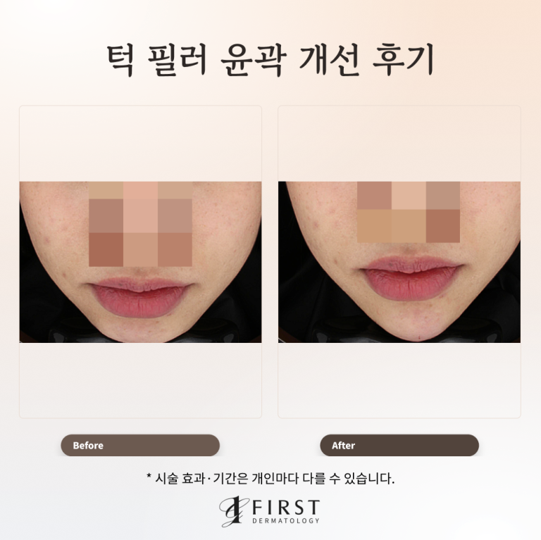 턱필러 후기