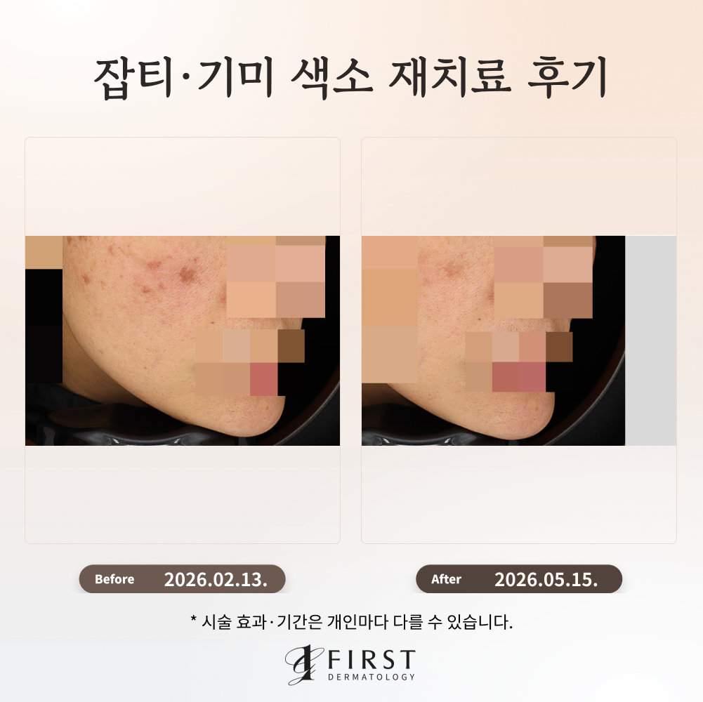 색소침착 부작용 치료 후기