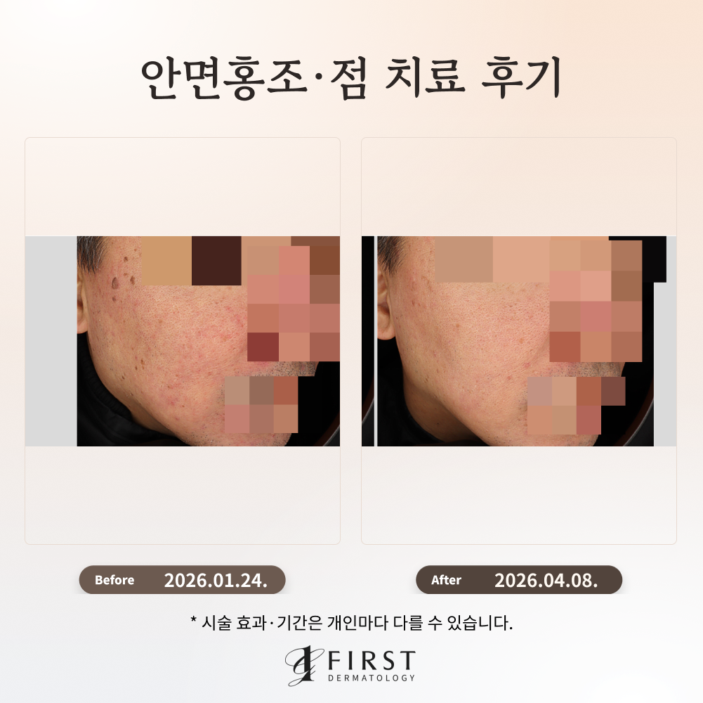 50대 남성 안면홍조·점 치료 후기