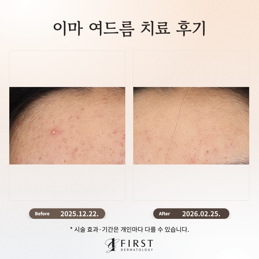 수원 이마 여드름 치료 후기