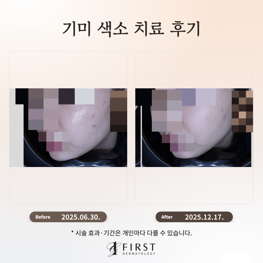 30대 기미·색소 침착 치료 후기
