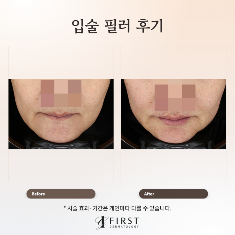 피부과 입술필러 후기