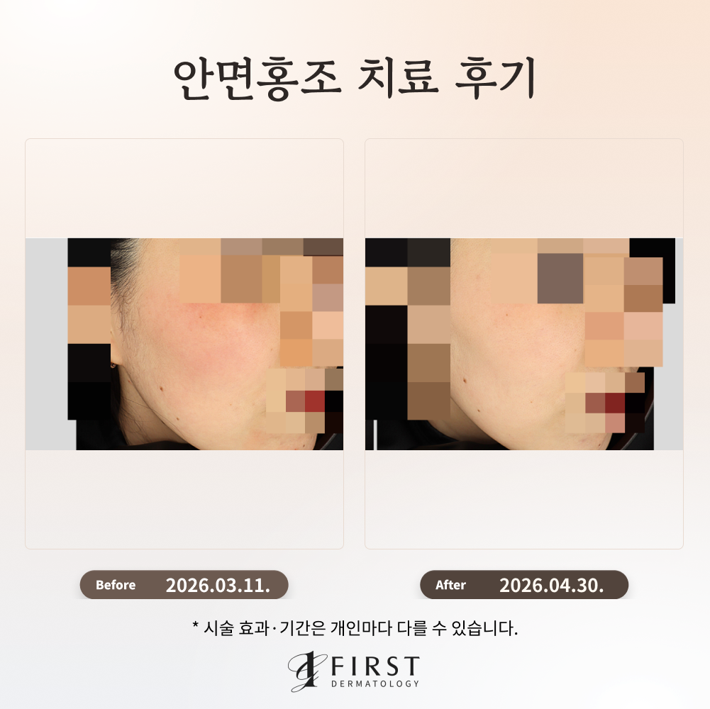 볼 부분 홍조 치료 후기