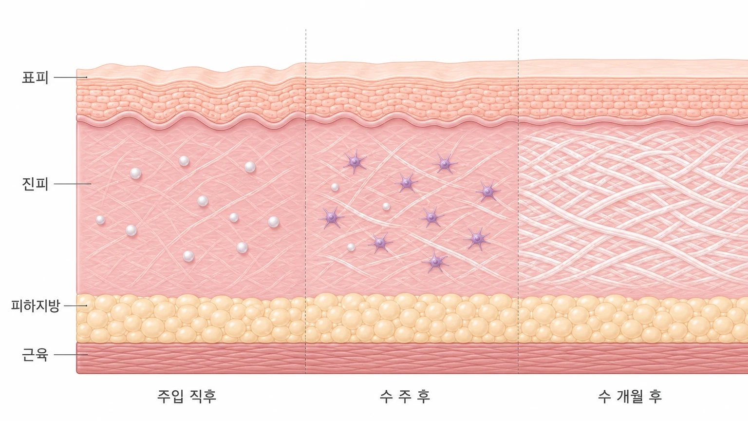 주입 직후 진피에 흩어진 스킨부스터 미세입자가 수 주 뒤 섬유아세포를 불러 모으고 수 개월 뒤 촘촘한 콜라겐 그물망으로 바뀌어 가는 과정을 좌우 3단계로 비교한 피부 단면 도해