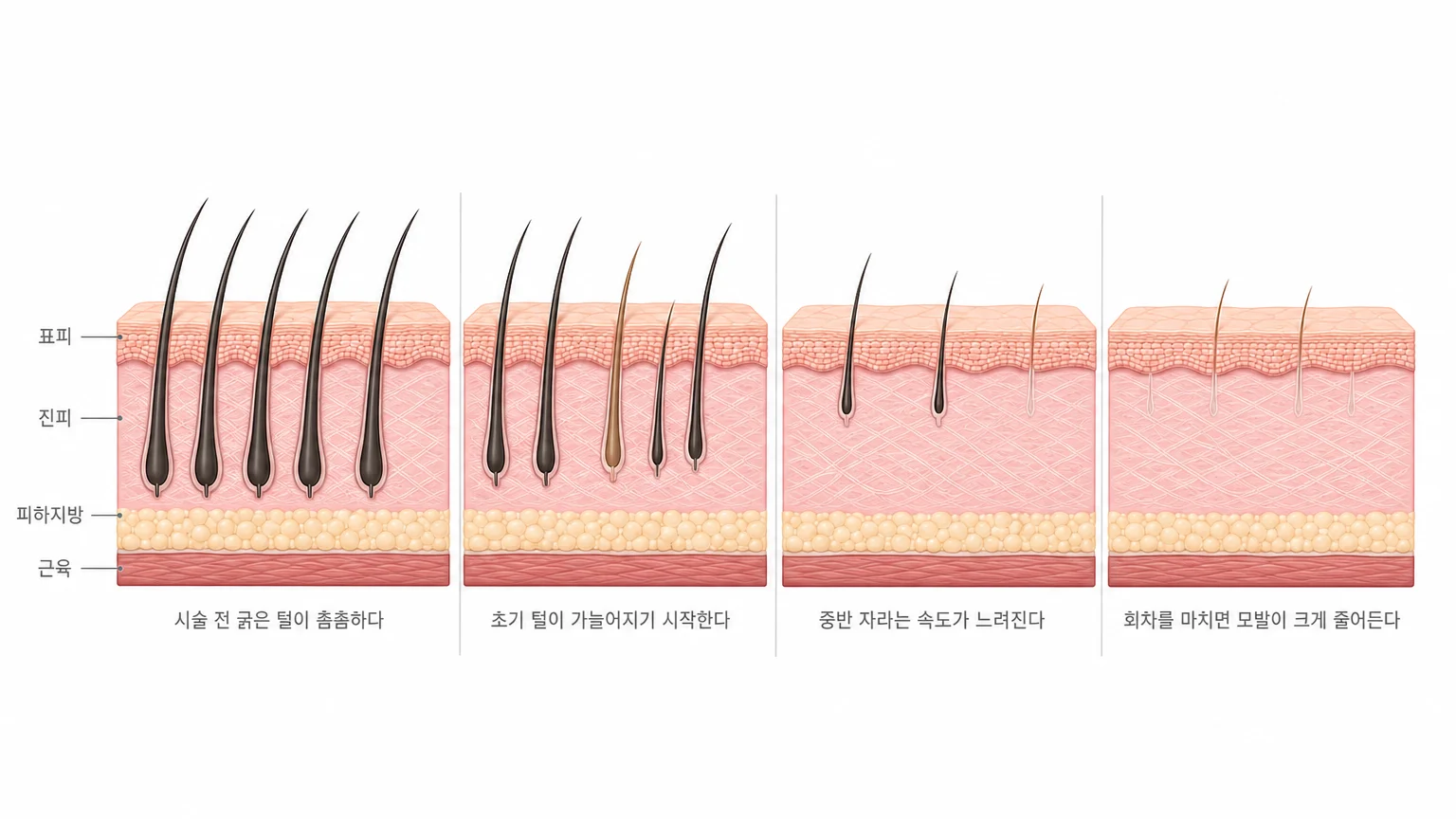 시술을 거듭할수록 모낭 수가 줄고 남은 털이 가늘어져 모발이 성글어지는 변화를 네 단계로 비교한 피부 단면 도해