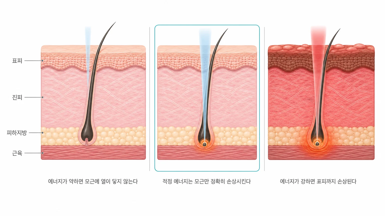 에너지가 약할 때·적정할 때·강할 때 모근과 표피에 나타나는 차이를 좌우로 비교한 피부 단면 도해 — 제모 시술의 에너지 강도 조절이 중요한 이유