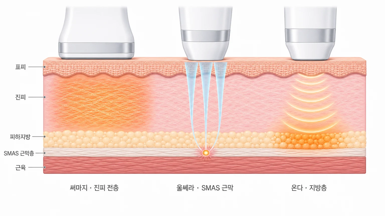 리프팅 3종 도달 깊이 비교 — 써마지는 진피 전층, 울쎄라는 SMAS 근막, 온다는 지방층에 작용하는 피부 단면 도해