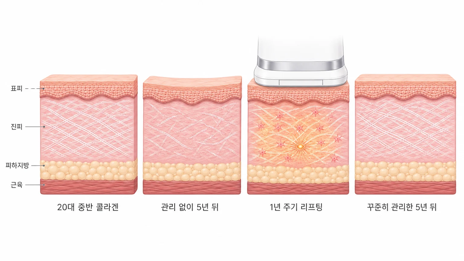 20대 중반의 콜라겐, 관리 없이 5년이 지난 진피, 1년 주기 리프팅 시술, 꾸준히 관리한 5년 뒤를 좌우로 비교한 콜라겐 소실 방지 4단계 피부 단면 도해