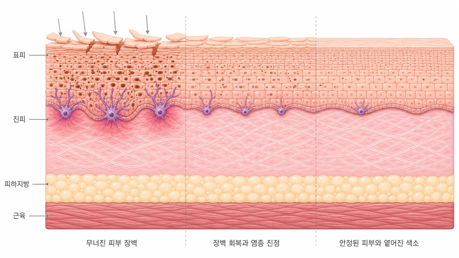 무너진 피부 장벽이 회복되며 염증이 가라앉고 색소가 옅어지는 세 단계를 좌우로 나열한 피부 단면 도해